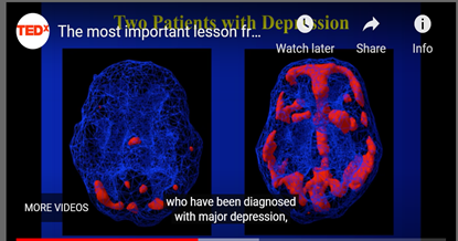 Brain Image of Depression by Daniel Amen