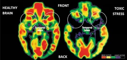 Brain image of Chronic  STRESS